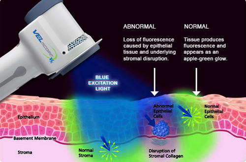 Velscope Oral Cancer Screening Oakville - VELscope Banner 03