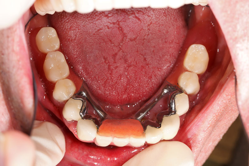 dental bridges to replace missing teeth