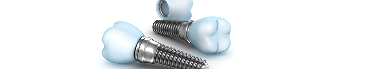  - Dental Implants