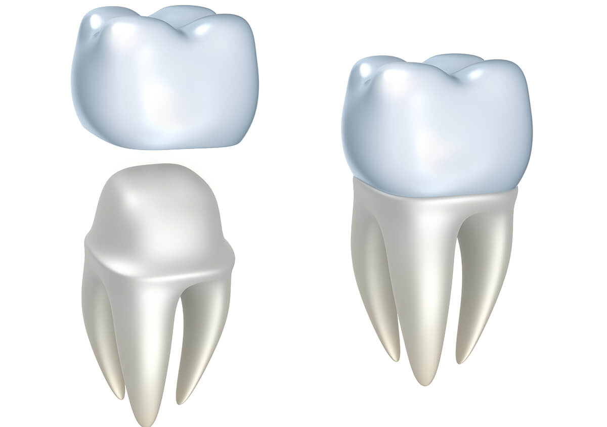 Dental Crowns at Sherwood Dental in Oakville Area