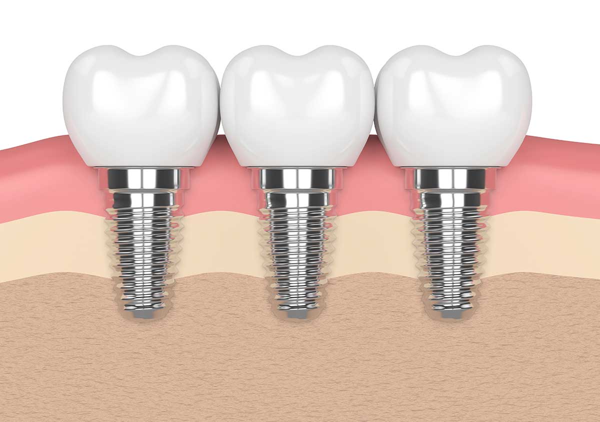 Teeth Implant Services Near Me Oakville Area