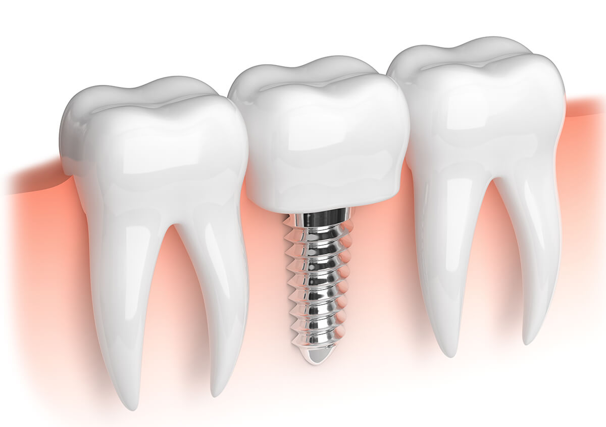 Are Teeth Implant Services Available in Oakville, Ontario Area?