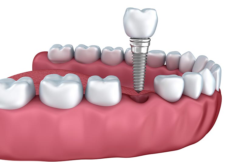 About Dental Implants Video